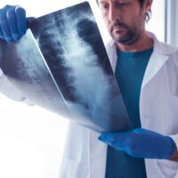 Cervical Spine Injuries After a California Car Accident